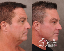 沈阳哪家拉皮手术做的好 沈阳哪家拉皮手术做的好