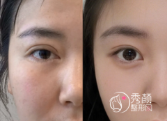 成都双眼皮修复医生排行 成都双眼皮修复医生排行