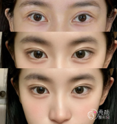 南昌割双眼皮哪个医院好 南昌割双眼皮哪个医院好