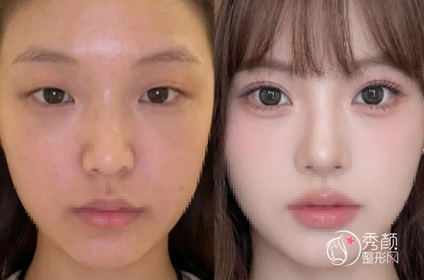 沈阳双眼皮手术哪家医院好?盛京医院、杏林、曙光、百嘉丽…拔得头筹