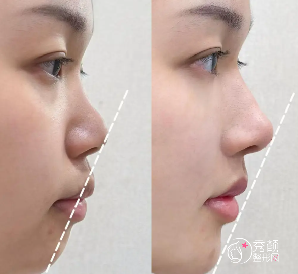 合肥做鼻子超好的整形医院是哪家?省立医院、安医大二附院、韩美…综合水准高