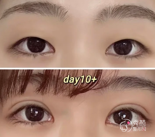 苏薇洁和徐晓斐谁厉害?两位都是行业内的人气眼整形专家