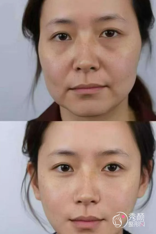 龙剑虹和雷少榕筋膜提升谁好?从基本背景、技术优势、手术风格来分析