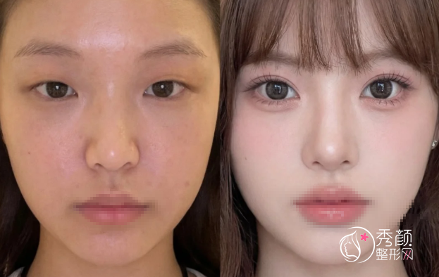 深圳双眼皮医生排名:牛克辉、朱武根、陈芝等医生实力上榜