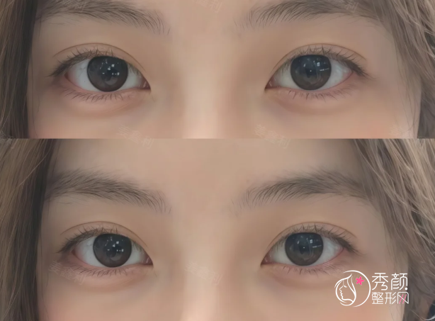 南京双眼皮医生排名:王小林、汪树杰、陈小剑等医生实力上榜