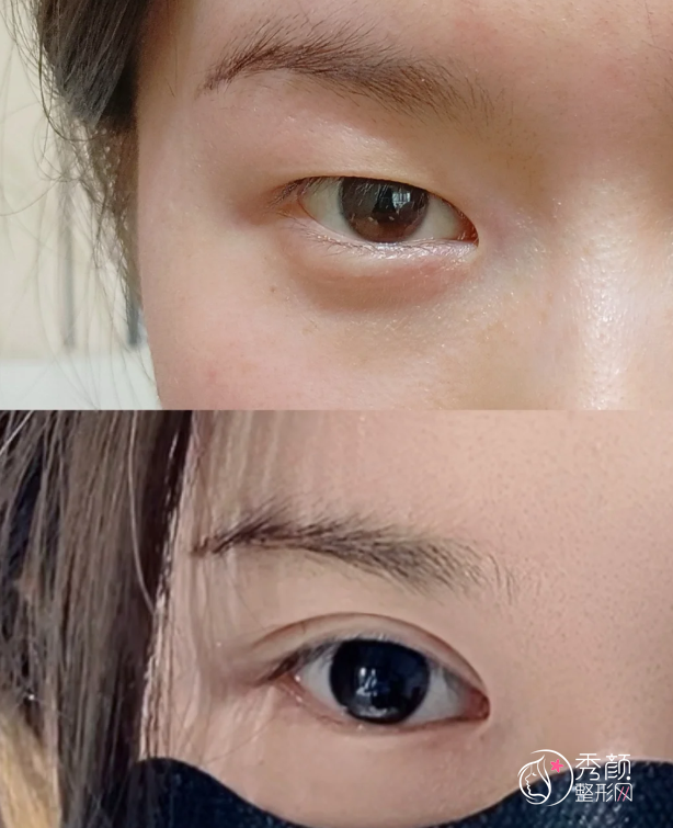 成都双眼皮医生排名:林靖、卢尚兵、高亮等医生实力上榜