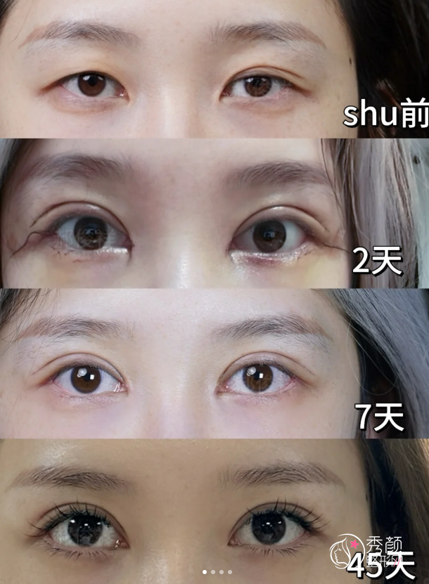 北京双眼皮医生排名:魏志香、张冰洁、师丽丽等医生实力上榜