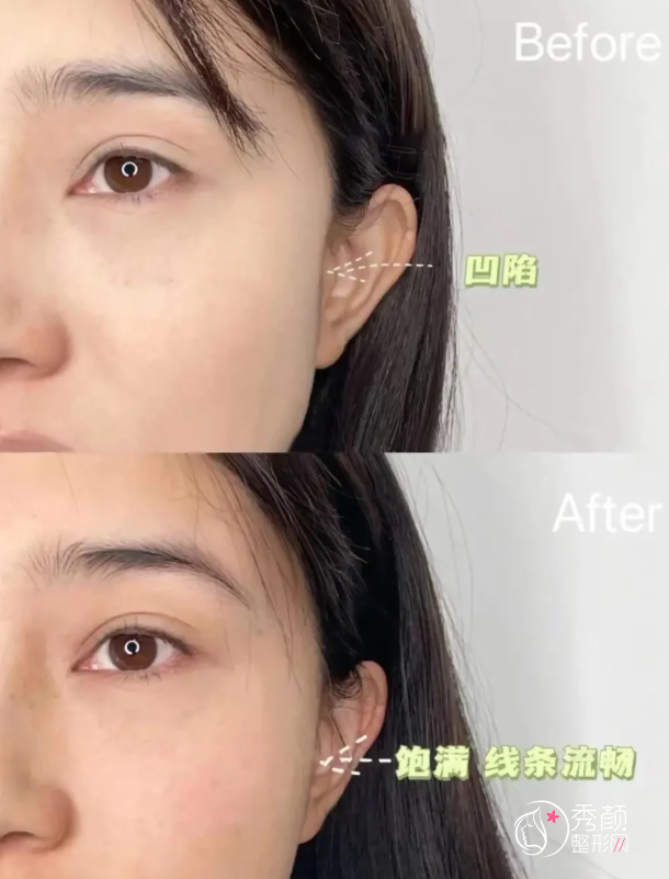 广州玻尿酸注射医生排名:李婧彤、陈超越、韦瑞莲等医生实力上榜