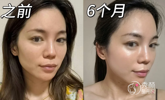 成都玻尿酸注射医生排名:谢雯、黄剑美、梁静萍等医生实力上榜