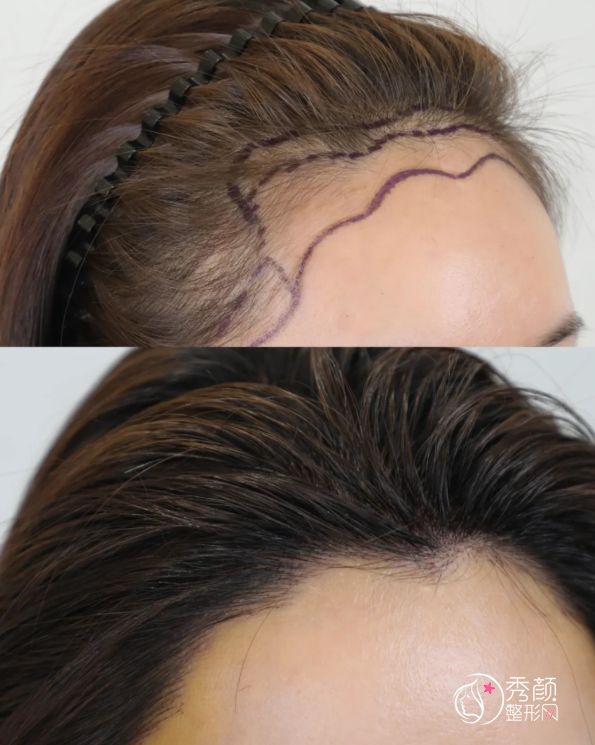 济南植发医生排名:高国强、葛瑞瑞、王克华等医生实力上榜