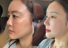 北京鼻综合医生排名:谢 北京鼻综合医生排名:谢