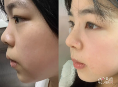 武汉鼻综合医生排名:杨 武汉鼻综合医生排名:杨