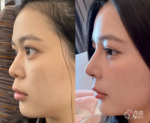 广州鼻综合医生排名:金 广州鼻综合医生排名:金