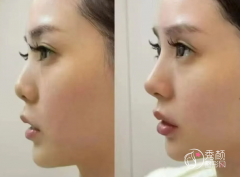 杭州鼻综合医生排名:徐 杭州鼻综合医生排名:徐