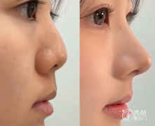 济南鼻综合医生排名:薛 济南鼻综合医生排名:薛