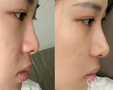 长沙鼻综合医生排名:王 长沙鼻综合医生排名:王