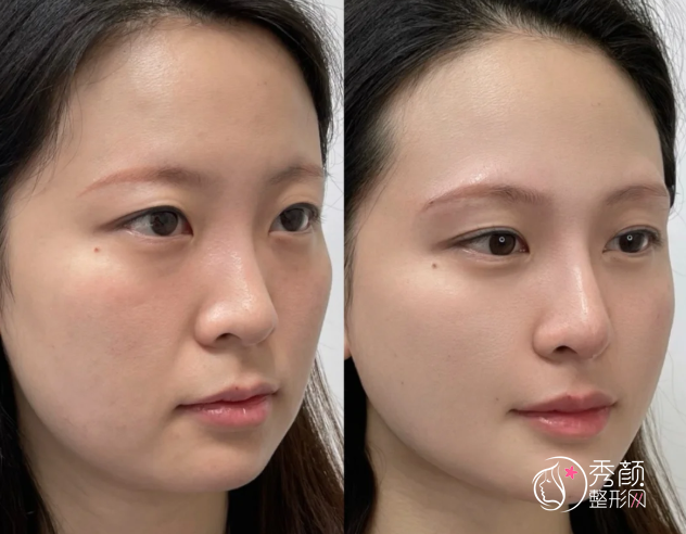 武汉自体脂肪丰面颊医生排名:秦垦、马行、赵月强等医生实力上榜