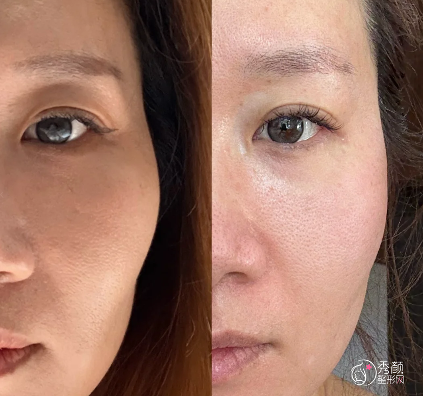 杭州颧骨内推医生排名:陈文才、陈小平、唐冬生、项昌峰等医生实力上榜