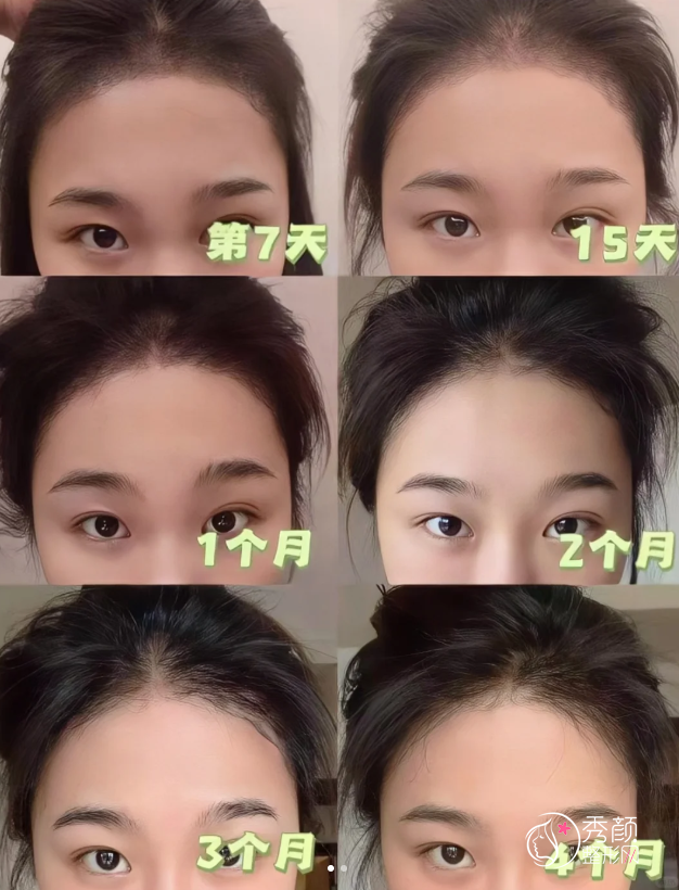 山东齐鲁医院植发多少钱一个毛囊,哪个医生好?植发医生介绍