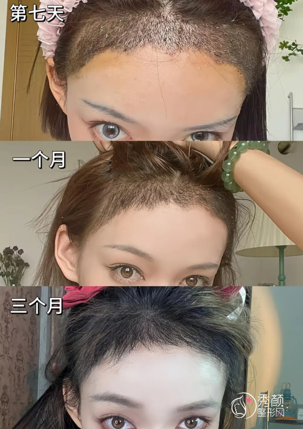 江苏省人民医院植发多少钱一个毛囊,哪个医生好?植发医生介绍