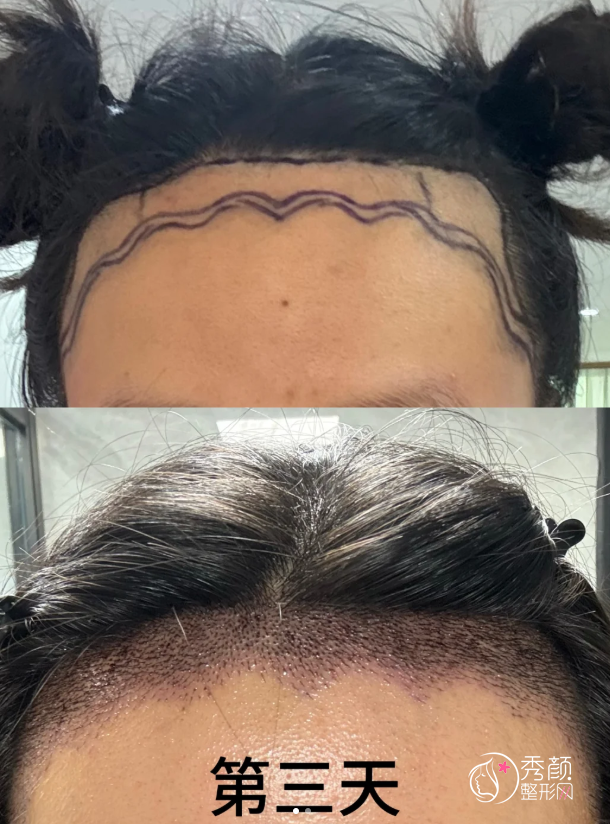 湘雅医院植发多少钱一个毛囊,哪个医生好?植发医生介绍