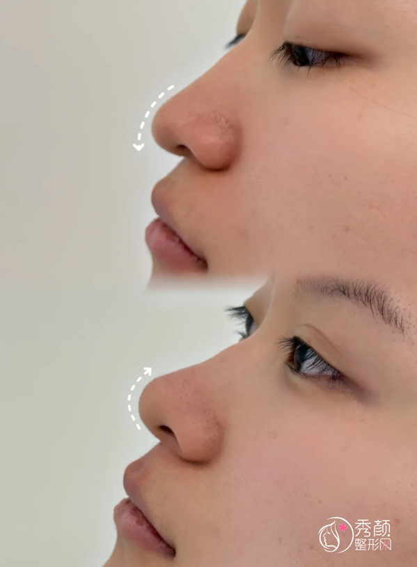 解放军总医院隆鼻多少钱?哪个医生好?隆鼻医生介绍