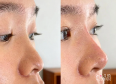 上海瑞金医院隆鼻多少钱 上海瑞金医院隆鼻多少钱