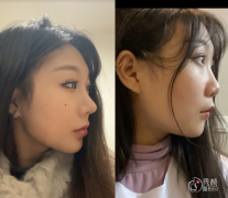 上海中山医院隆鼻多少钱 上海中山医院隆鼻多少钱