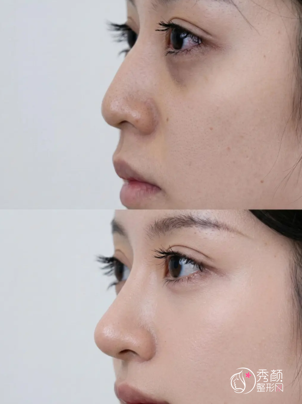 郑大一附院隆鼻多少钱?哪个医生好?隆鼻医生介绍