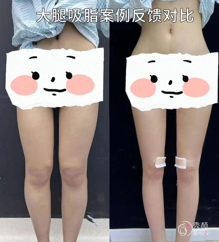 广州市第一人民医院吸脂多少钱,哪个医生好?王原路等吸脂医生介绍