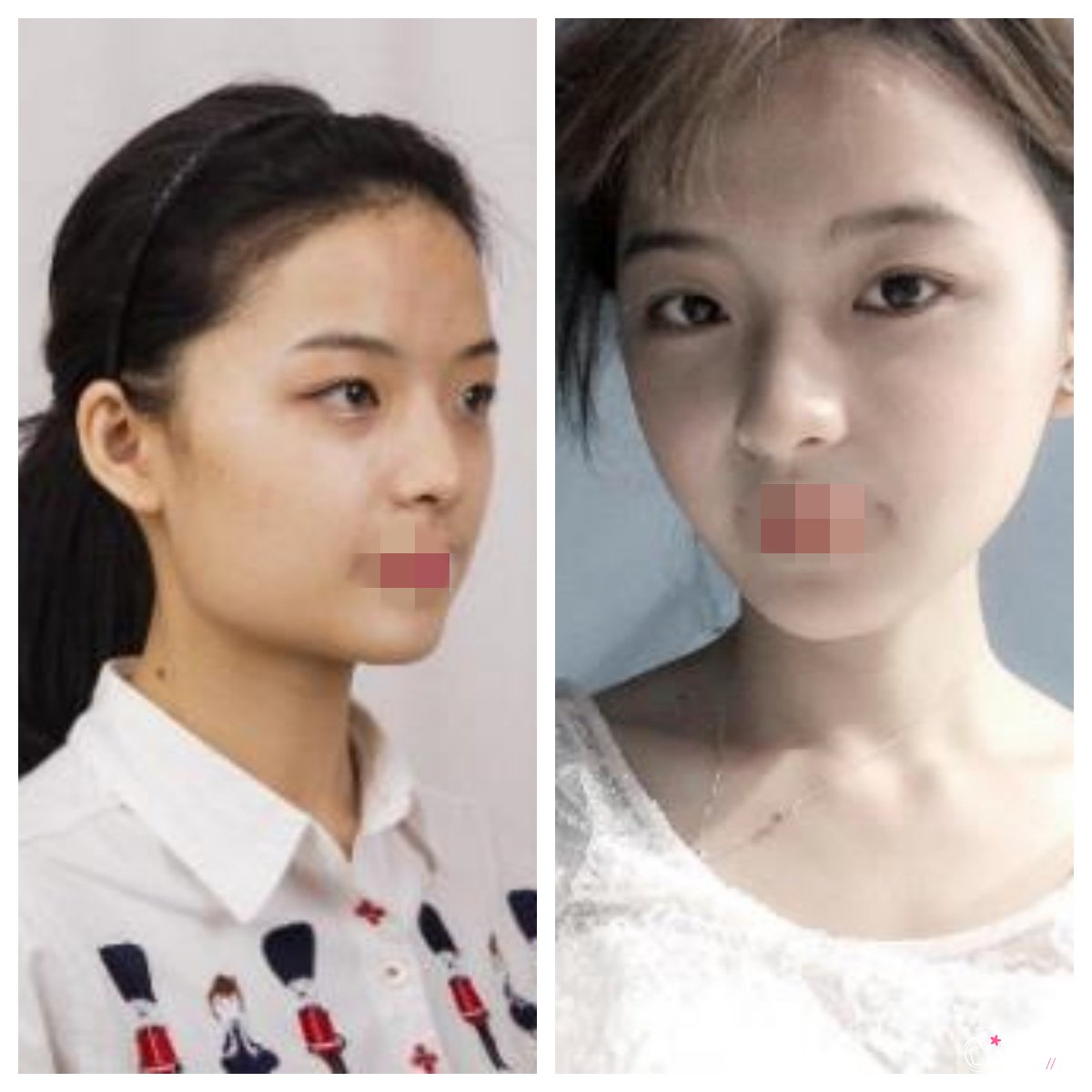 天津磨骨有什么危害和后遗症?面部麻木、面部左右不对称…