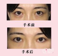 广州外切去眼袋会留疤吗 广州外切去眼袋会留疤吗