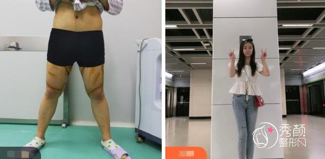 南京腰腹环吸大概多少钱?南京腰腹环吸哪家整形医院做的好?