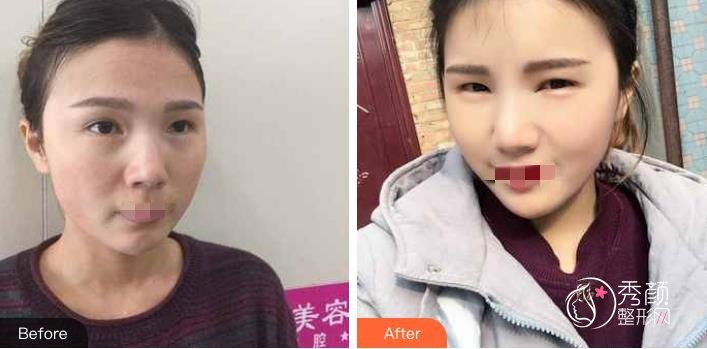 郑州脸部自体脂肪填充价格多少钱?郑州脸部自体脂肪填充哪家医院做的好?