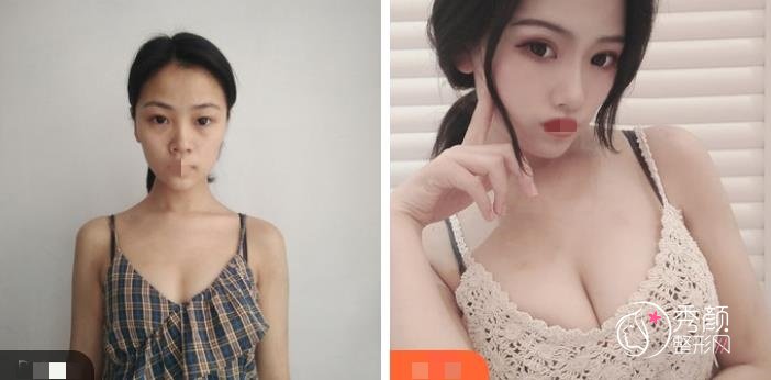 自体脂肪隆胸填充能支撑几年?南宁自体脂肪隆胸填充哪家医院技术好?