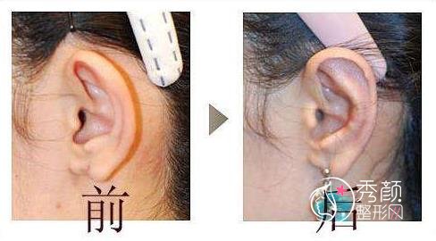 耳再造取肋软骨有影响吗?北京耳再造哪家医院好?