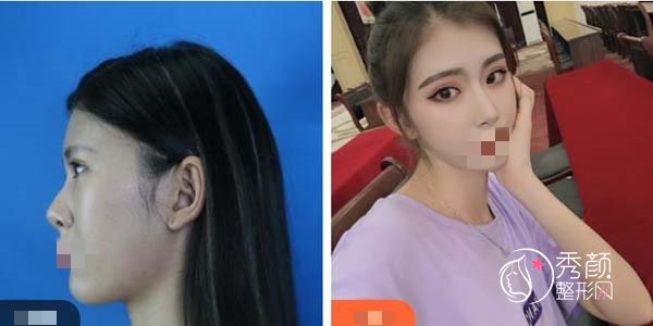 濡白天使隆鼻可以定型吗?杭州濡白天使隆鼻哪家好?