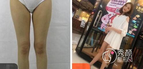 南充中心医院吸脂怎么样?田超、蒋婷等技术强,内含大腿吸脂案例