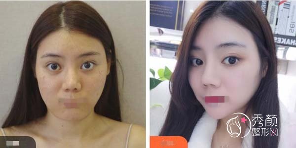 华西吸脂哪个医生好?肖海涛、岑瑛、卿勇实力强,内含面部吸脂案例