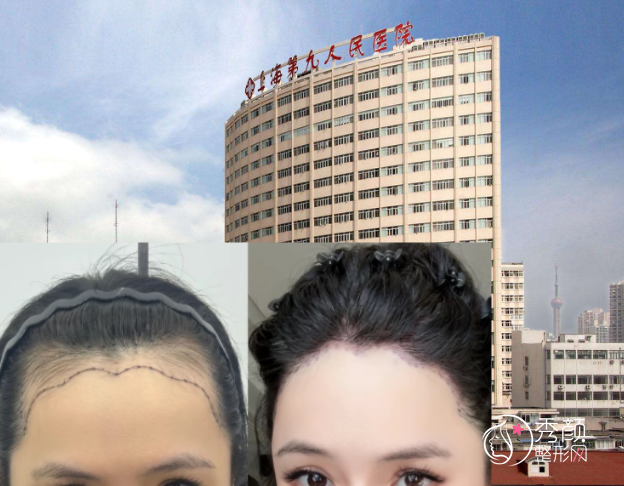上海九院植发怎么样,贵不贵,哪个医生好?详细介绍