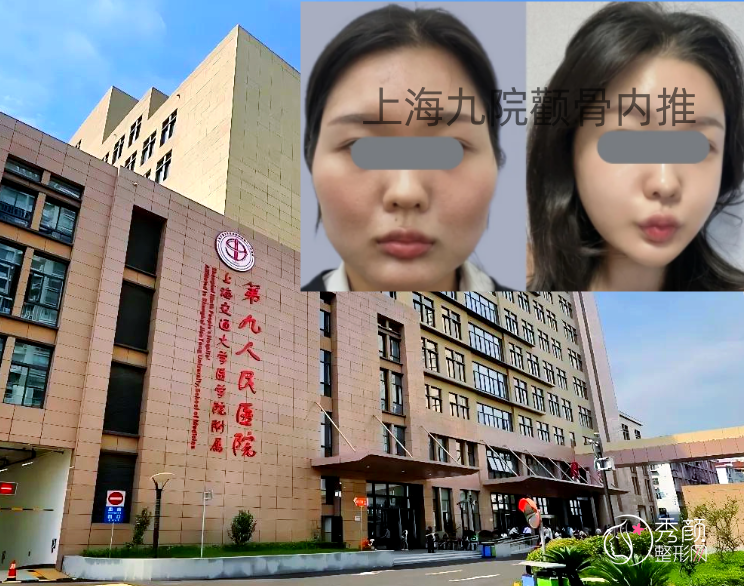 上海九院颧骨内推手术做得怎么样,多少钱?柴岗等磨骨医生介绍