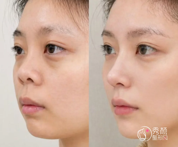 上海隆鼻哪家医院好?上海伯思立、上海华美、联合丽格等医院靠谱
