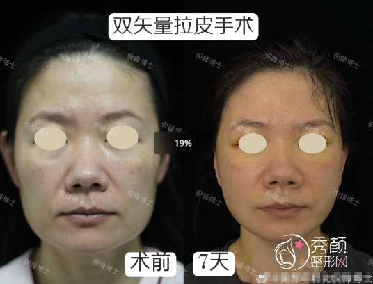上海伯思立倪锋拉皮手术做得怎么样?颞部mini小拉皮29800元起