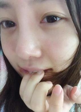 鼻翼缩小+面部自体脂肪填充一起，妹子敢做就敢