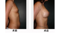 自体脂肪隆胸价格