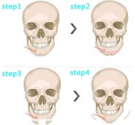 磨骨手术有风险吗