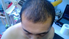 雄性激素源性脱发