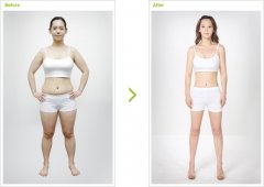 吸脂减肥没问题吗