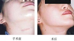 修复疤痕
