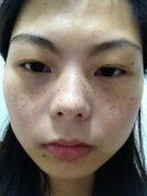 祛斑果较好的方法有哪些